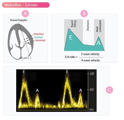 lv ee|Assessment of diastolic function by echocardiography.